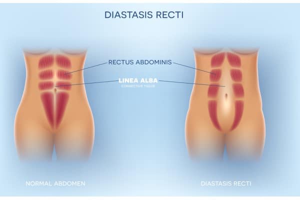 What Non-Surgical Options Are Available for Diastasis Recti Moss Side?