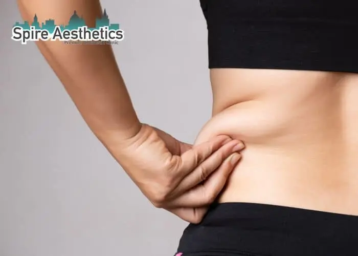Image of woman pinching fat on their hips Moss Side. Fat Freezing treatment