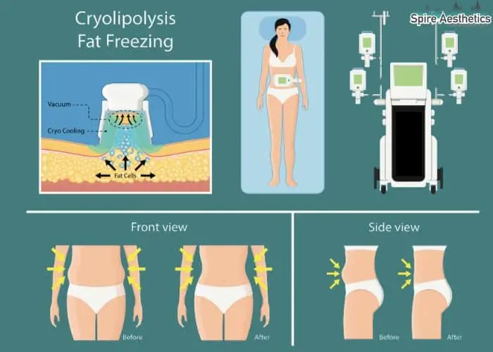 Fat freezing treatment Moss Side benefits for competitions to remove stubborn fat deposits.