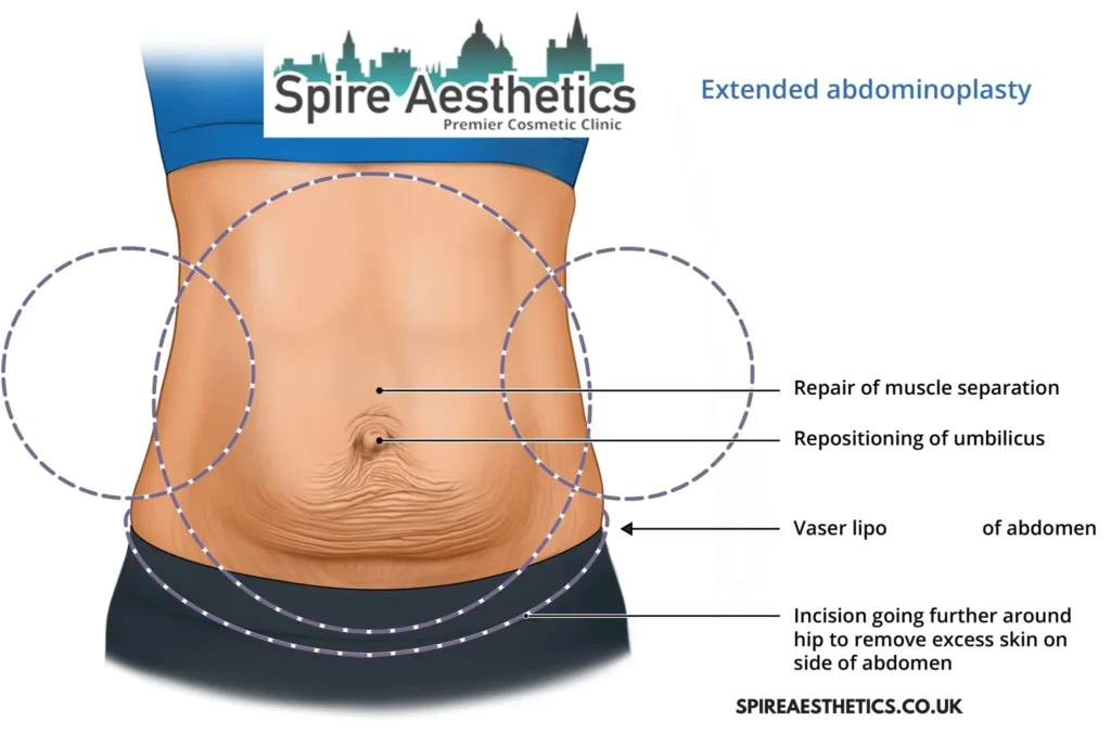 Understanding Loose Skin After Gastric Band Moss Side Surgery and HIFU Treatment