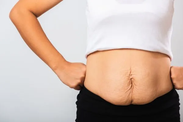 Image of a woman's stomach after weight loss with sagging skin following a gastric band Moss Side