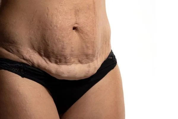 Image of womans stomach after weight loss injections Moss Side showing saggy skin