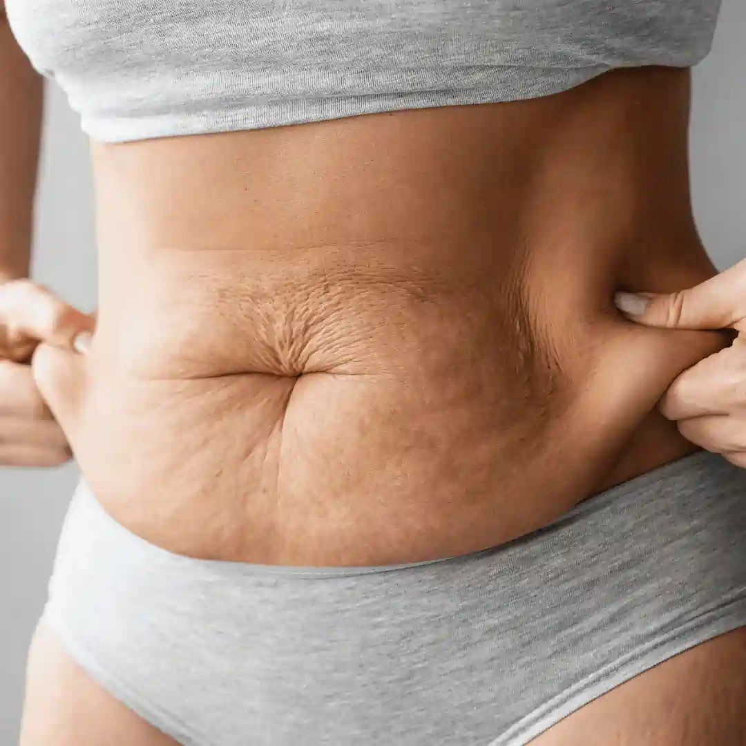 Is It Normal to Have Loose Skin After Pregnancy Moss Side?